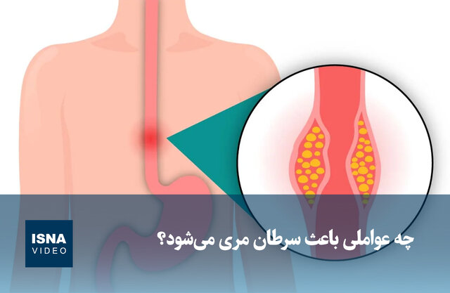 ویدیو/ چه عواملی باعث سرطان مری میشود؟ ویدیو/ چه عواملی باعث سرطان مری میشود؟