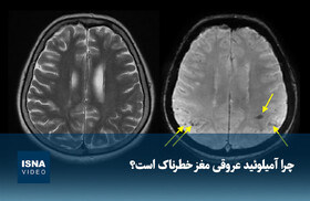 ویدیو/ چرا آمیلوئید عروقی مغز خطرناک است؟