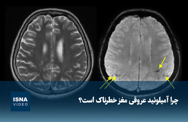 ویدیو/ چرا آمیلوئید عروقی مغز خطرناک است؟