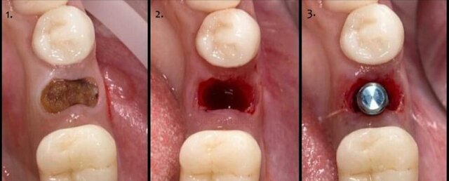 مراقبت های بعد از ایمپلنت فوری که باید بدانید