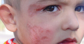 کاهش ۵۰ درصدی ابتلا به سالک در یزد/ارائه دو میلیون خدمت بهداشتی در یک سال