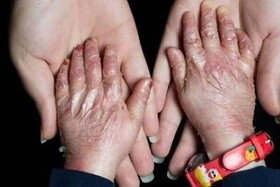 هزینه‌های سرسام‌آور و محدودیت دسترسی به دارو، زندگی بیماران نادر را سخت‌تر کرده است