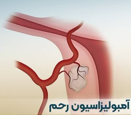 بستن موفق  رگ‌های خون‌رسان فیبرومِ بزرگِ رحمی در مرکز شهید رجایی کرج