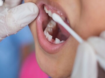فلورایدتراپی دانش‌آموزان قمی در پایگاه‌های سلامت انجام می‌شود