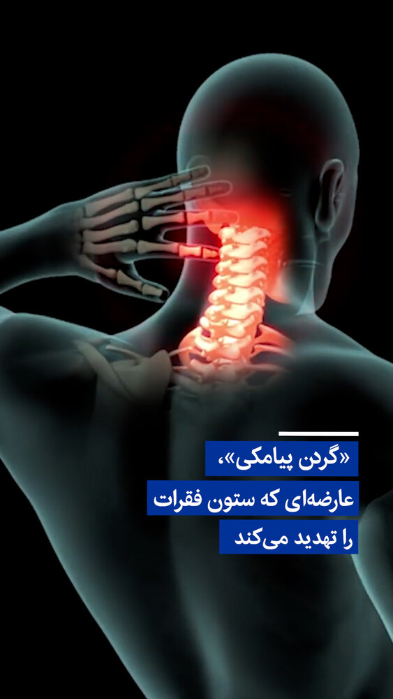 ویدیو/ «گردن پیامکی»، عارضه‌ای که ستون فقرات را تهدید می‌کند