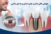عوارض خالی ماندن جای دندان /چرا ایمپلنت مهم است