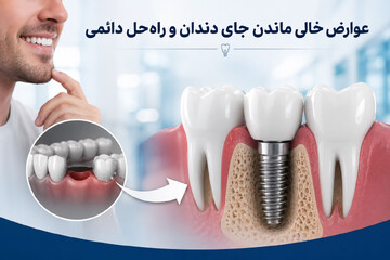عوارض خالی ماندن جای دندان /چرا ایمپلنت مهم است