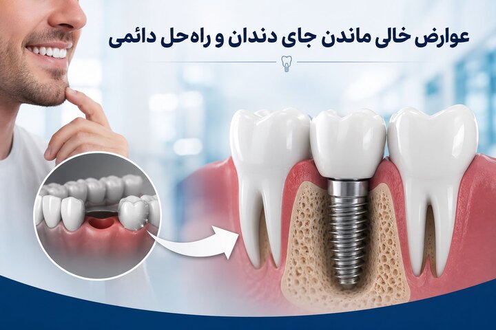 عوارض خالی ماندن جای دندان /چرا ایمپلنت مهم است