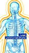 ویدیو/ لوپوس؛ بیماری هزار چهره سیستم ایمنی