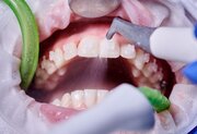 لمینت دندان در غرب تهران؛ انتخابی حرفه‌ای برای اصلاح طرح لبخند