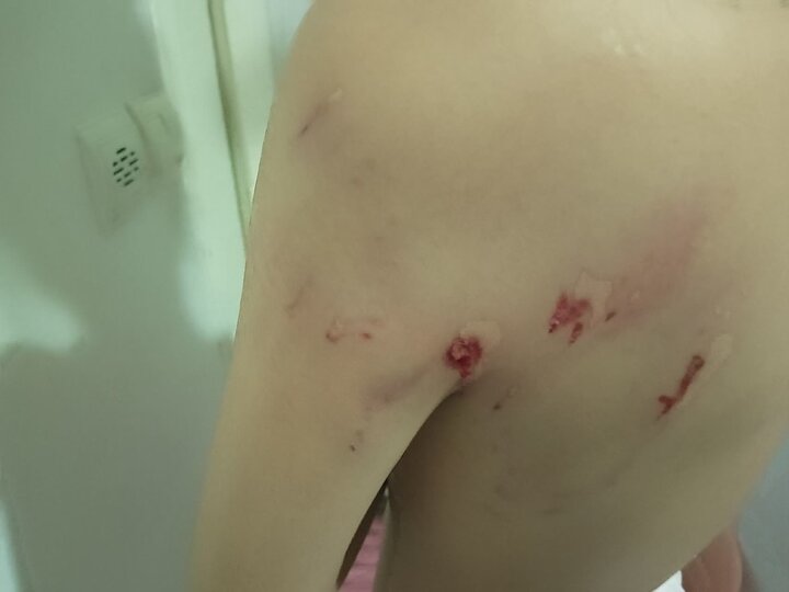 حمله سگ‌های بلاصاحب به دختر ۱۲ ساله در سنندج؛ زنگ خطر مدیریت شهری و مطالبه امنیت شهروندان
