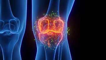 پیشگیری از آرتروز با امواج فراصوت