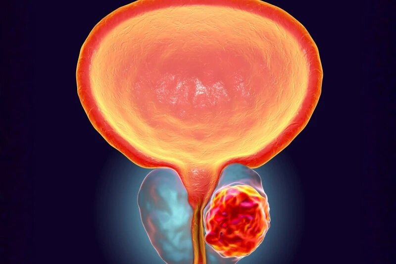 Prostate cancer growth halted with a new treatment