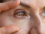 دلایل پارگی رگ خونی در چشم؛ چه موقع باید به پزشک مراجعه کنیم؟