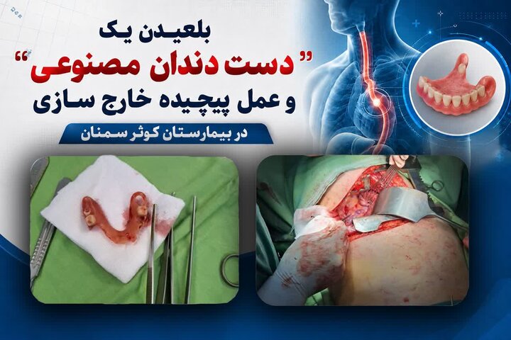 خارج کردن یک دست دندان مصنوعی از مری یک مرد ۶۲ ساله در سمنان