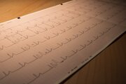 از سندرم مرگ ناگهانی بزرگسالان چه می‌دانید؟