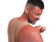 تنها یک آفتاب‌سوختگی شدید می‌تواند سلامت ما را برای همیشه تغییر دهد