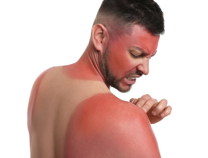 تنها یک آفتاب‌سوختگی شدید می‌تواند سلامت ما را برای همیشه تغییر دهد