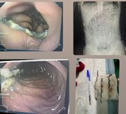 خروج سه قطعه فنس از دستگاه گوارش جوان ساوجی