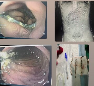 خروج سه قطعه فنس از دستگاه گوارش جوان ساوجی