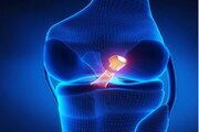 مقایسه دو روش ترمیم مینیسک زانو در پژوهش محققان ایرانی