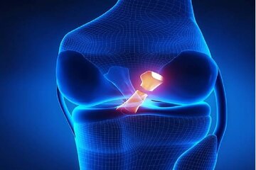 مقایسه دو روش ترمیم مینیسک زانو در پژوهش محققان ایرانی