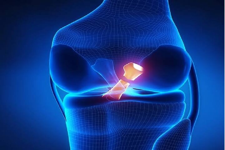 مقایسه دو روش ترمیم مینیسک زانو در پژوهش محققان ایرانی