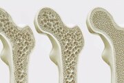 راهنمای جامع پیشگیری و کنترل پوکی استخوان  