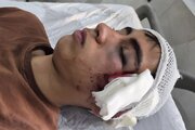 مصدومیت شدید دانش‌آموز دهبکری بم توسط معلم