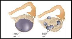 کیست تخمدان و راه های درمان آن