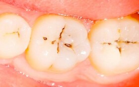 پوسیدگی دندان شایع‌ترین بیماری دهان است