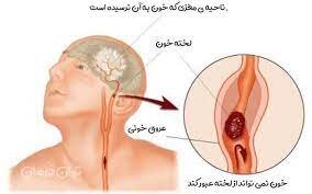 اختراع دستگاه هشداردهنده لخته خون به همت مخترع پارس‌آبادی