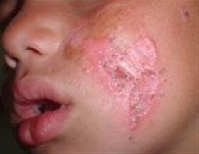 شناسایی ۱۳۰ بیمار مبتلا به سالک در اسفراین