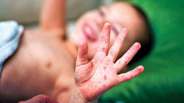 ۸ کودک مبتلا به سرخک در استان بوشهر شناسایی شدند