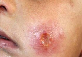 افزایش شیوع سالک در جهرم/ بیماران برای درمان اقدام کنند