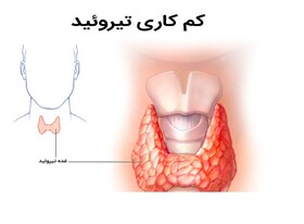 بی علامتی مشکل تیروئید در نوزادان و ضرورت غربالگری 