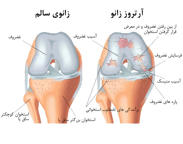 آرتروز زانو علل و عوارض و درمان