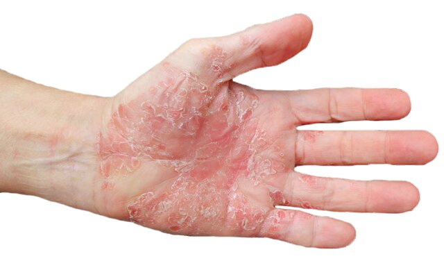 تراژدی تلخ کمبود دارو دامن بیماران پوستی را هم گرفت