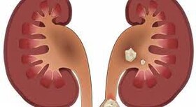 افراد چاق و مردان بیشتر به سنگ کلیه مبتلا می‌شوند