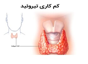 ۶۱ کودک مبتلا به کم‌کاری تیروئید تحت درمان قرار گرفتند