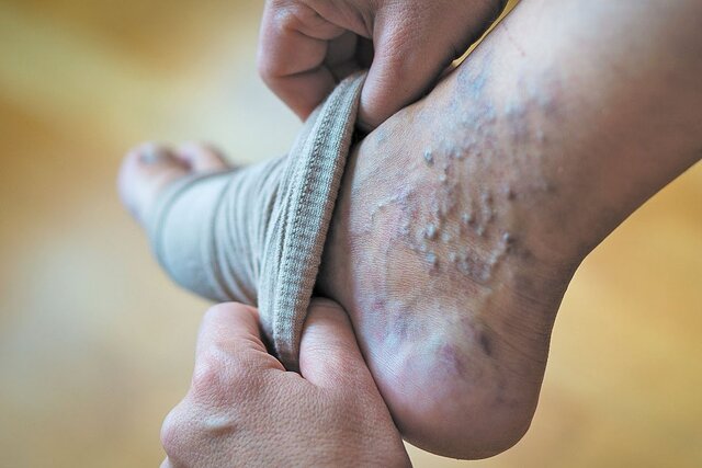 عفونتهای درماننشده در کودکی، تهدیدی برای دریچههای قلب در میانسالی