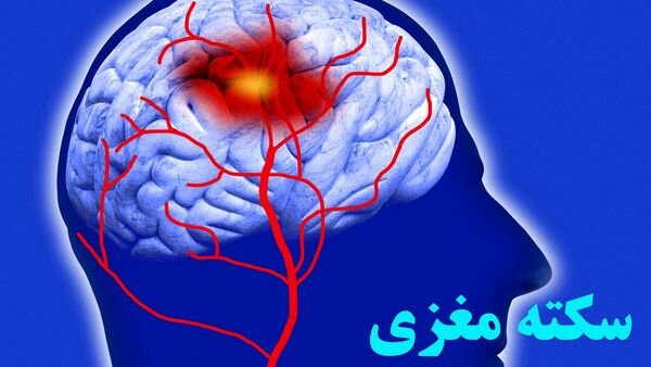 آیا موارد زمینه ساز و علائم سکته مغزی را می شناسید؟