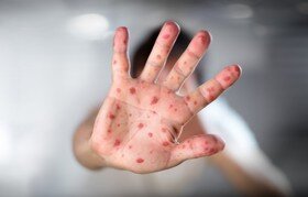 مورد قطعی ابتلا به سرخک در رفسنجان و انار شناسایی نشده است