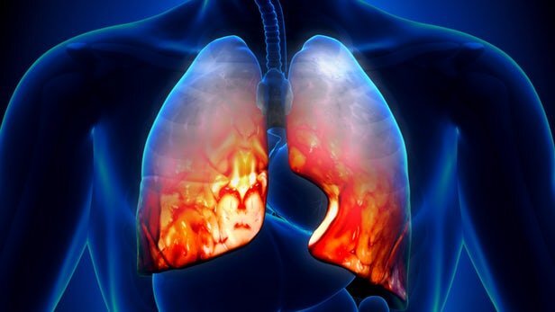 از "پنومونی" چه می دانید؟ 