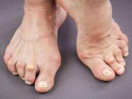 بیماران مبتلا به "نقرس" این نکات تغذیه‌ای را رعایت کنند 