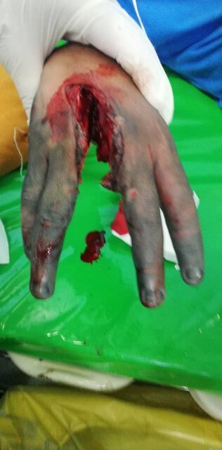 مصدومین "چهارشنبه سوری" کرمانشاه به 69 نفر رسید/ فعلا فوتی و مورد حاد نداشته ایم