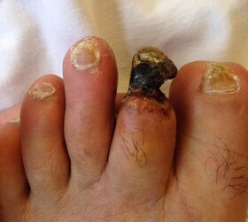 این بیماری در کمین "انگشت" سیگاری‌ها است!