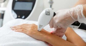 موهای زائد بدن را "لیزر" نکنید!