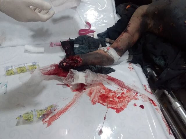 قطع 2 دست نوجوان روانسری بر اثر انفجار "مواد محترقه"