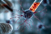 آلزایمر؛ از مرز باریک تشخیص تا زنگ خطر علائم